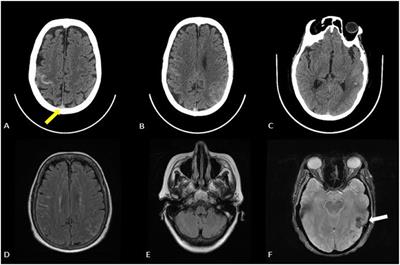 First off Label Endovascular Clinical Experience to Treat Diffuse Cerebral Venous Sinus Thrombosis Using the INARI FlowTriever System: Case Report